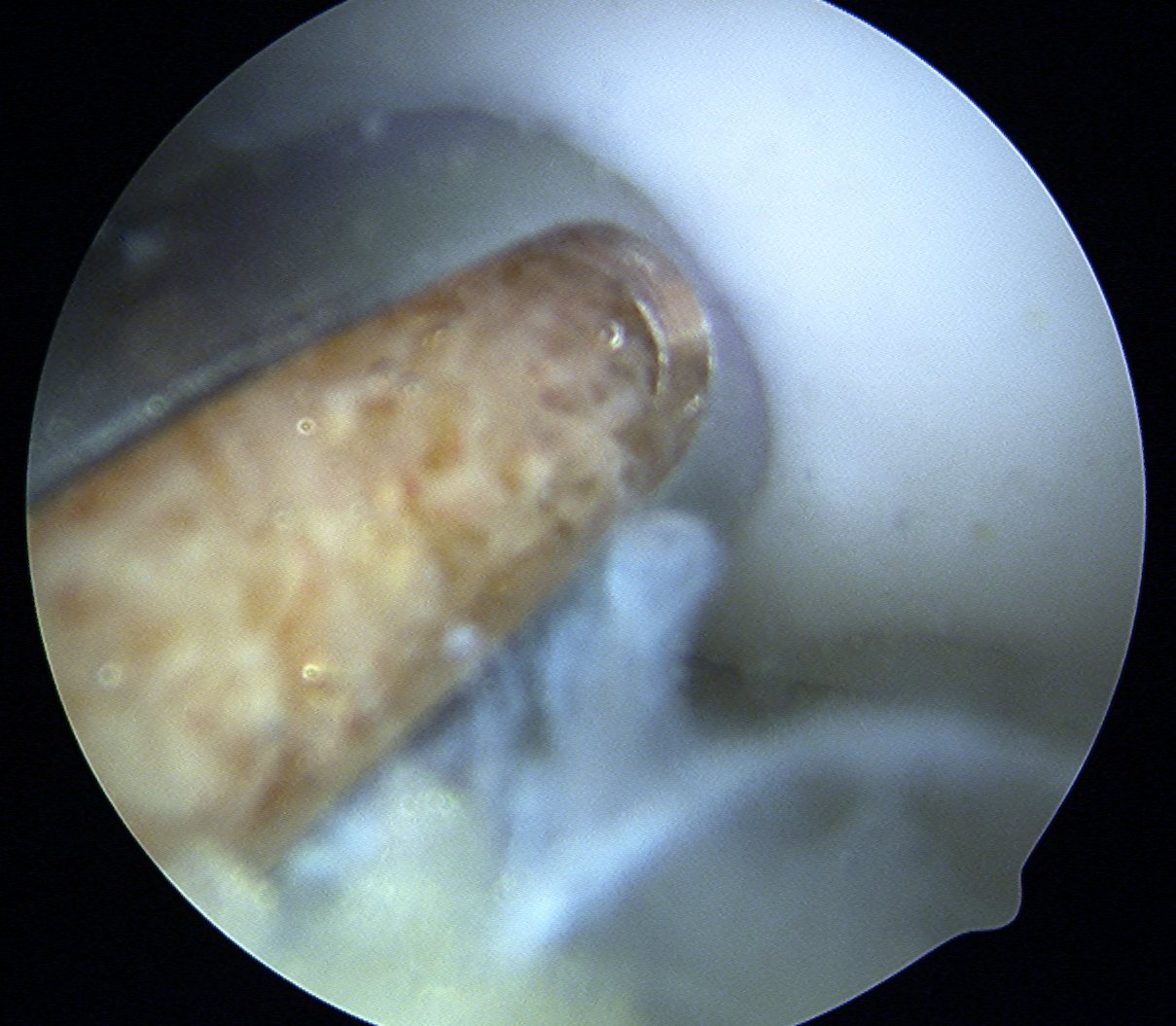 Mosaicplasty Plug Impaction